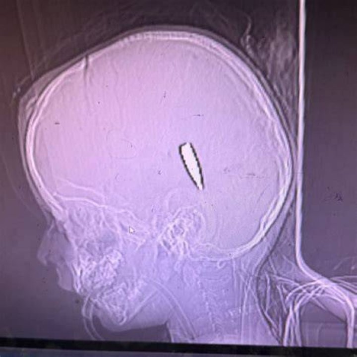 Can a nail in the head kill you?