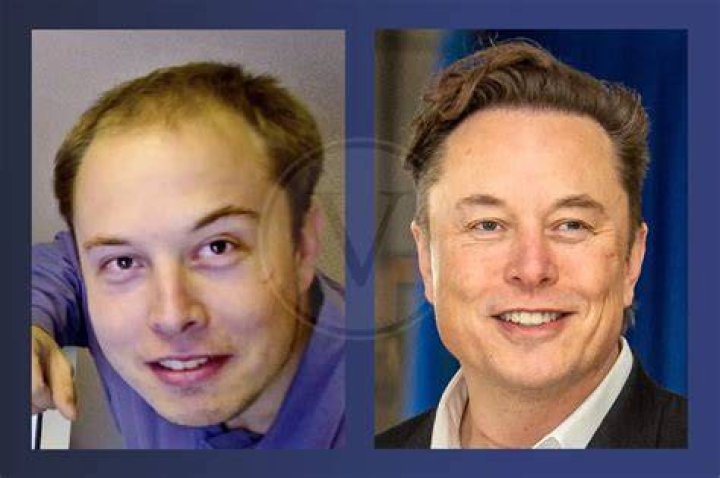 Did Elon Musk Get a Hair Transplant?