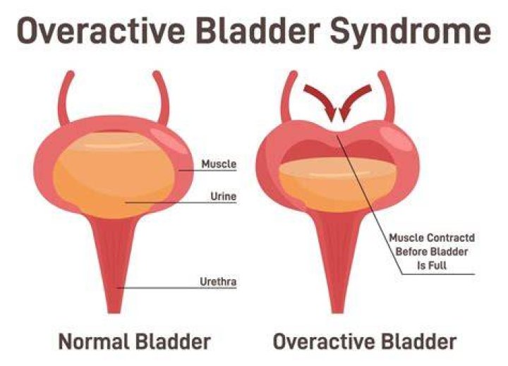 Does Hypnotism Work on an Overactive Bladder?