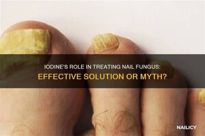 Does iodine kill fungal infections?