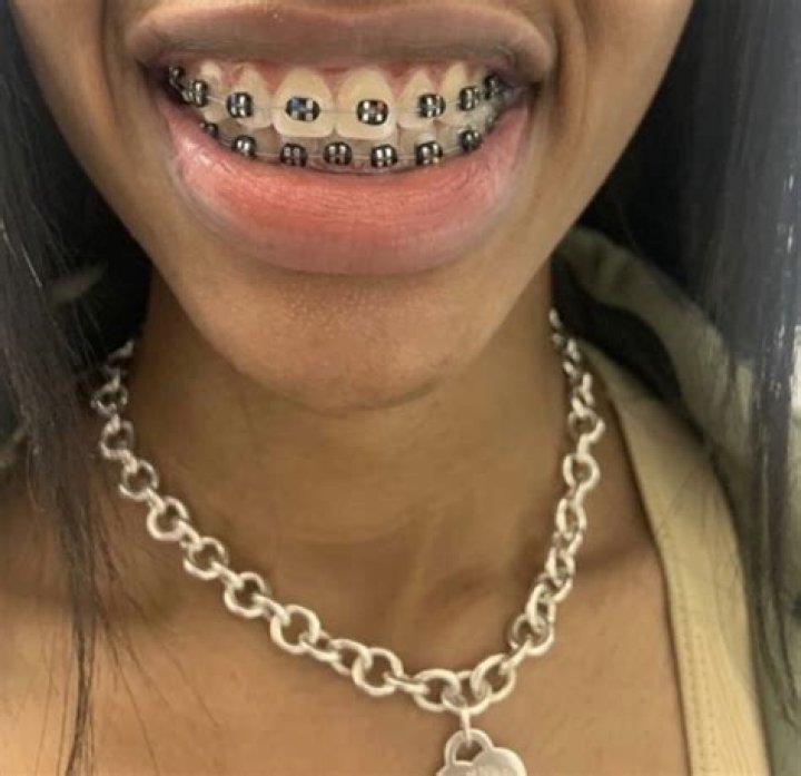 Fans Suspect Brittany Banks Has Fake Braces for the Attention