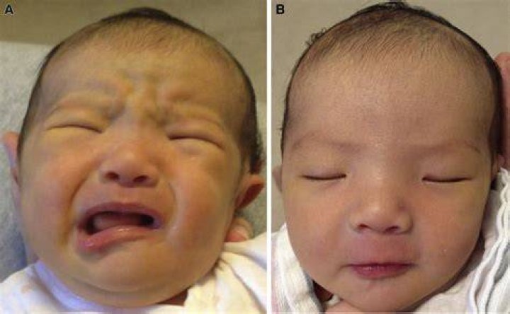 Is congenital asymmetric crying facies really due to absence of the