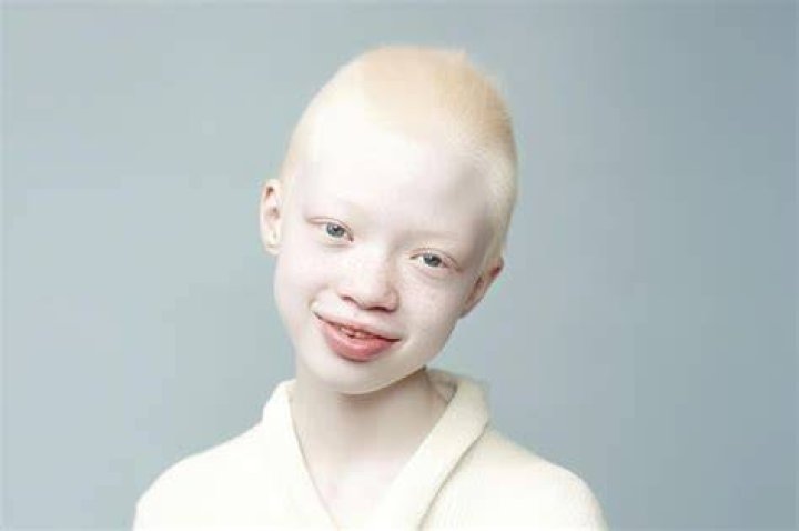 Waarom Is De Iris Van Een Albino Rood?