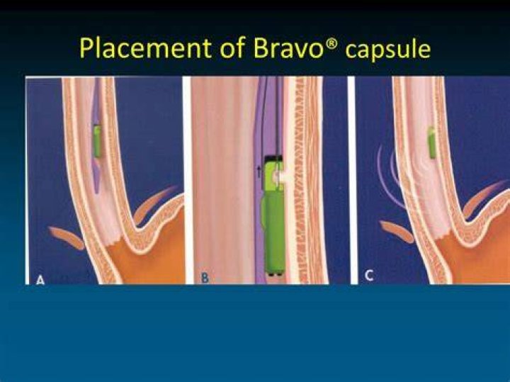 What is EGD with Bravo placement?
