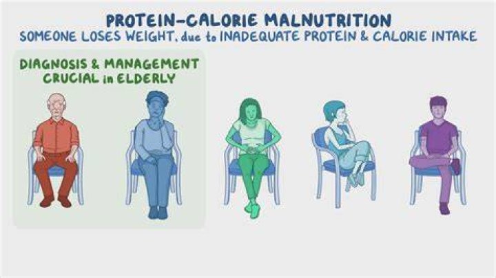 What is meant by protein calorie malnutrition?